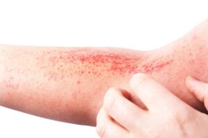 Park-Avenue-Dermatology-Hand-Foot-and-Mouth-Disease-Spots-On-Arm